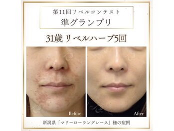 マリーローラン グレース/リベルハーブピーリング