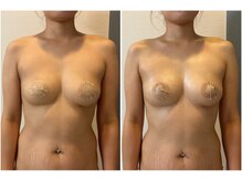 モア(moa)/バストUP!!肩周りもスッキリ♪