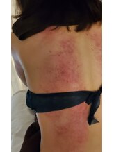 ネスト(nest)/カッピング、スライドカッピング