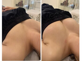 エムプリュ 心斎橋店(M.plus)/オススメ！光豊胸バスト★☆