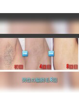 ラクト サロン(RAKT salon)/脇脱毛！8回目の経過写真！