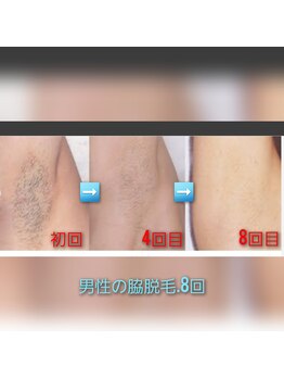 ラクト サロン(RAKT salon)/脇脱毛！8回目の経過写真！