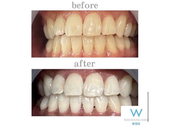 ホワイトニングショップ 新潟店/ホワイトニングビフォーアフター