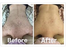 フィオーレ/背中美肌・美白♪ブライダル等に