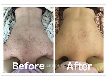 フィオーレ/背中美肌・美白♪ブライダル等に