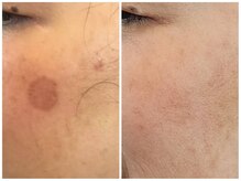 ビィーチェ(VIECE)/【結果写真】8回&フェイシャル