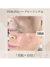 お顔そりローズマリー/ハーブピーリング