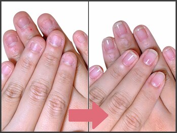 アモ 坂戸(’Amo)/深爪矯正・自爪育成 坂戸/北坂戸