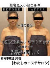 わたしの 大阪枚方本店/コルギでたるみ、ほうれい線改善