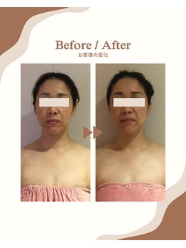 ビーキュート 学芸大学店(BE-CUTE)/Before/After 施術