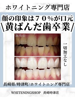 ホワイトニングショップ 長崎時津店/Before&After美白ホワイトニング