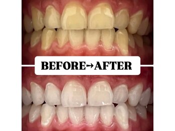 ホワイトニングサロン 豊中/Before&After美白ホワイトニング