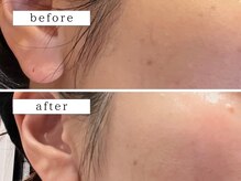 ビューティズムラウンジ(Beautism Lounge)/エクソソーム水光ジェット