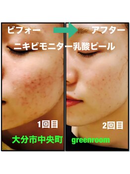 グリーンルーム(green room)/ニキビケアモニター2回目