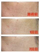 サロンメレ(Salon Mele)/日本製・漢方ハーブピーリング