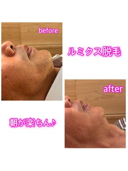 ヘルシースリム 東浦和/ヒゲ脱毛で朝が楽ちん♪