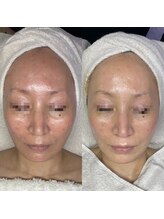 ジョンミー(JONMEE)/ハーブピーリングでくすみ改善