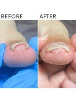 クオッカ(Quokka)/巻き爪ケア