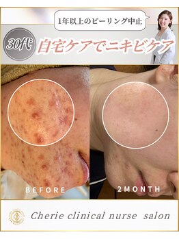 シェリー(Cherie)/施術なし！長年悩むニキビケア