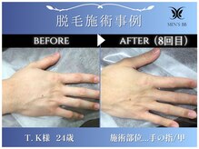 メンズビービー 福井高柳店(MEN'S BB)/ボディ脱毛施術事例
