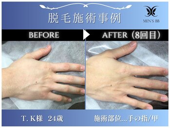 メンズビービー 福井高柳店(MEN'S BB)/ボディ脱毛施術事例