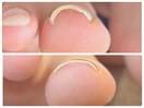 【巻き爪】フットネイルの前に☆