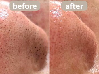 ラティエル(Latiele)/毛穴エクストラクション120分