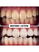ホワイトニングサロン 豊中/Before&After美白ホワイトニング