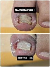 巻き爪じゅん 千葉駅前店/丁寧な施術で着実に改善を実感！