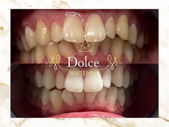 ドルチェ(Dolce)/ビフォーアフター