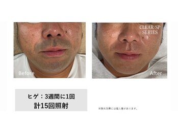 サロン ルアナ(salon luana)/ヒゲ脱毛　before→after