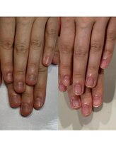 ティアラネイル 宇都宮/深爪矯正