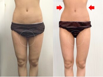 ステイゴールド美容整体院(STAY GOLD)/お腹のくびれ作り！