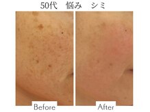 ファニービー 吹田店/50代 シミ 8ヶ月で改善