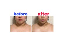 エルナ(Elna)の雰囲気(レモンボトルフェイシャルのBefore→After)
