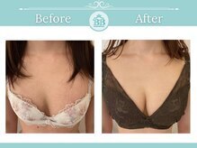 ベルビューティー(belle beauty)/【バストの左右差悩み症例】