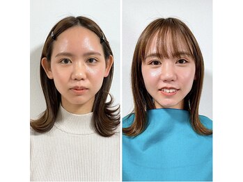 エピファニー 東京 銀座/ビフォーアフター(Y.N様 20代)