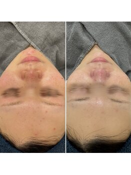 ラ クレール ビューティーサロン(LA CLAIR)/レチノールピール