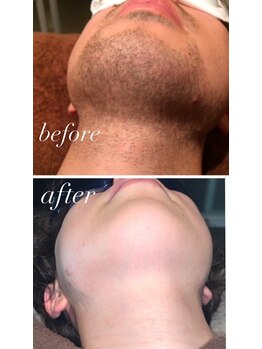 ラナンス 千早(LANUNCE)/髭脱毛