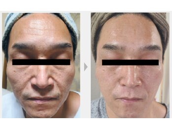 Nビューティー/最新RFサーモシェイプオーパス