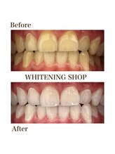 ホワイトニングショップ 岸和田店/お客様のBefore  After