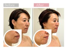 フロリール アザブジュウバン(FlorirAzabujuban)/幹細胞導入×造顔フェイシャル