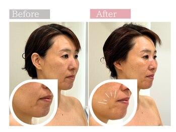 フロリール アザブジュウバン(FlorirAzabujuban)/幹細胞導入×造顔フェイシャル