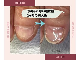 やめられない噛む癖