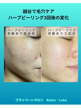 リレア ラカ(Relair Laka)/ハーブピーリングで毛穴ケア