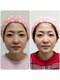 スピリッツ 西宮夙川店の写真/憧れの小顔へ!リフトアップ・面長・エラ張り・ほうれい線などのお悩みを解消!憧れのフェイスラインへ☆