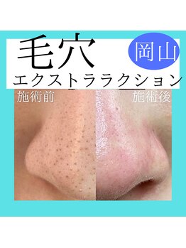 サロンこころ/1回でこの効果！毛穴ケア