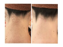 オム/襟足シェービング