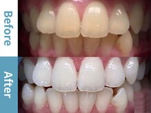 アース 岡崎店(EARTH)/【ビフォーアフター】美白