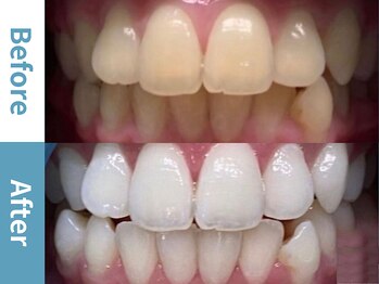 アース 岡崎店(EARTH)/【ビフォーアフター】美白